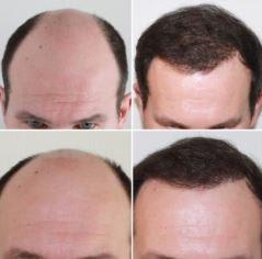 Images Capital Hair Restoration