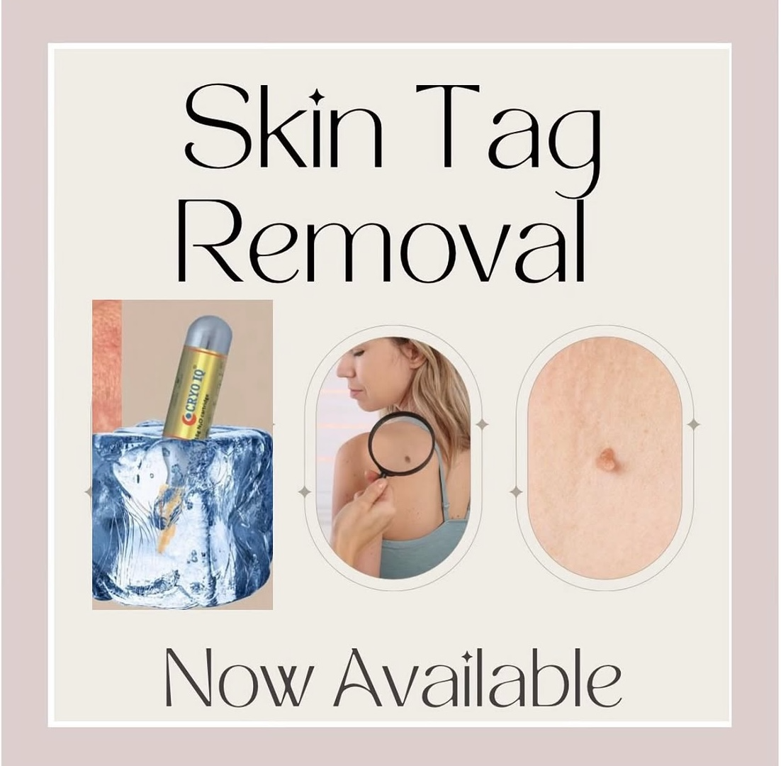 Cryotherapy treatment in action at KWJ Skin Clinic, a skin and aesthetic clinic in Broadbridge Heath, Horsham, offering cryotherapy, skin tag removal, sunspot removal and blemish removal.