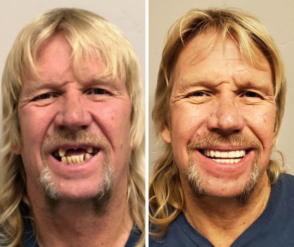 Before and After from Stubbs Dental | Layton, UT