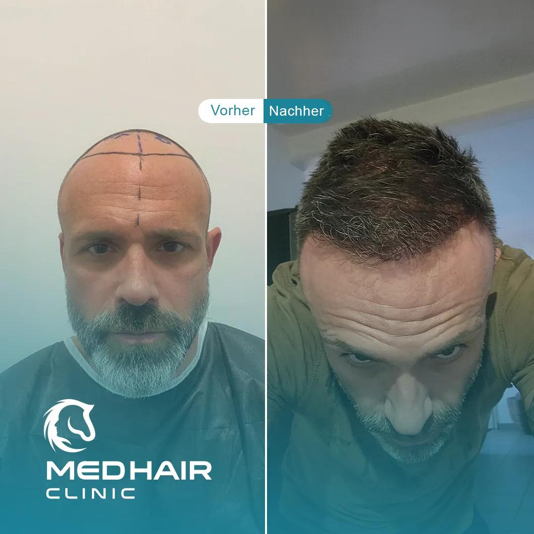 MedHair Clinic | Haartransplantationen in der Türkei Istanbul, Höninger Weg 176 in Rodenkirchen