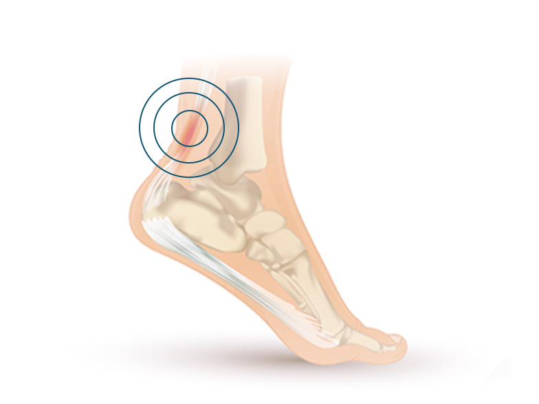 Cncrns_Cndtns-PlantarFasciitis-achlles-392x294@2x.jpg