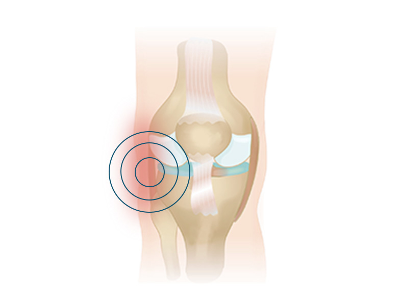 Cncrns_Cndtns-kneepain-outerknee-392x294@2x.jpg