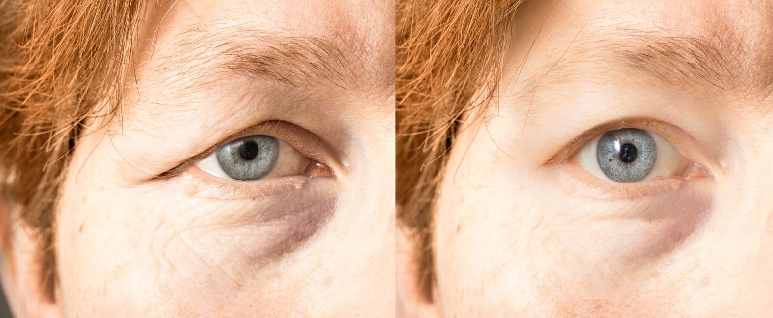 Before & After Results at Arizona Eye Institute & Cosmetic Laser Center | Sin City, AZ