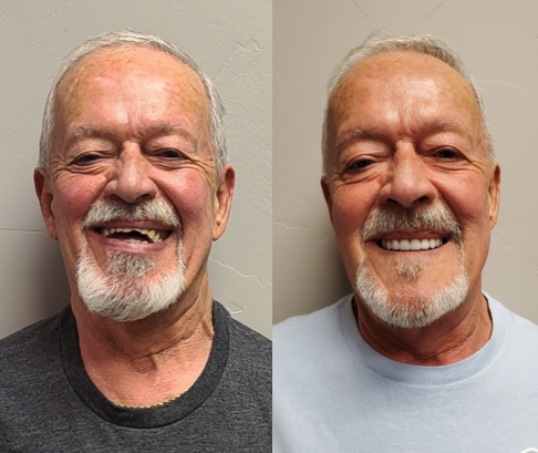 Before and After from Stubbs Dental | Murray, UT