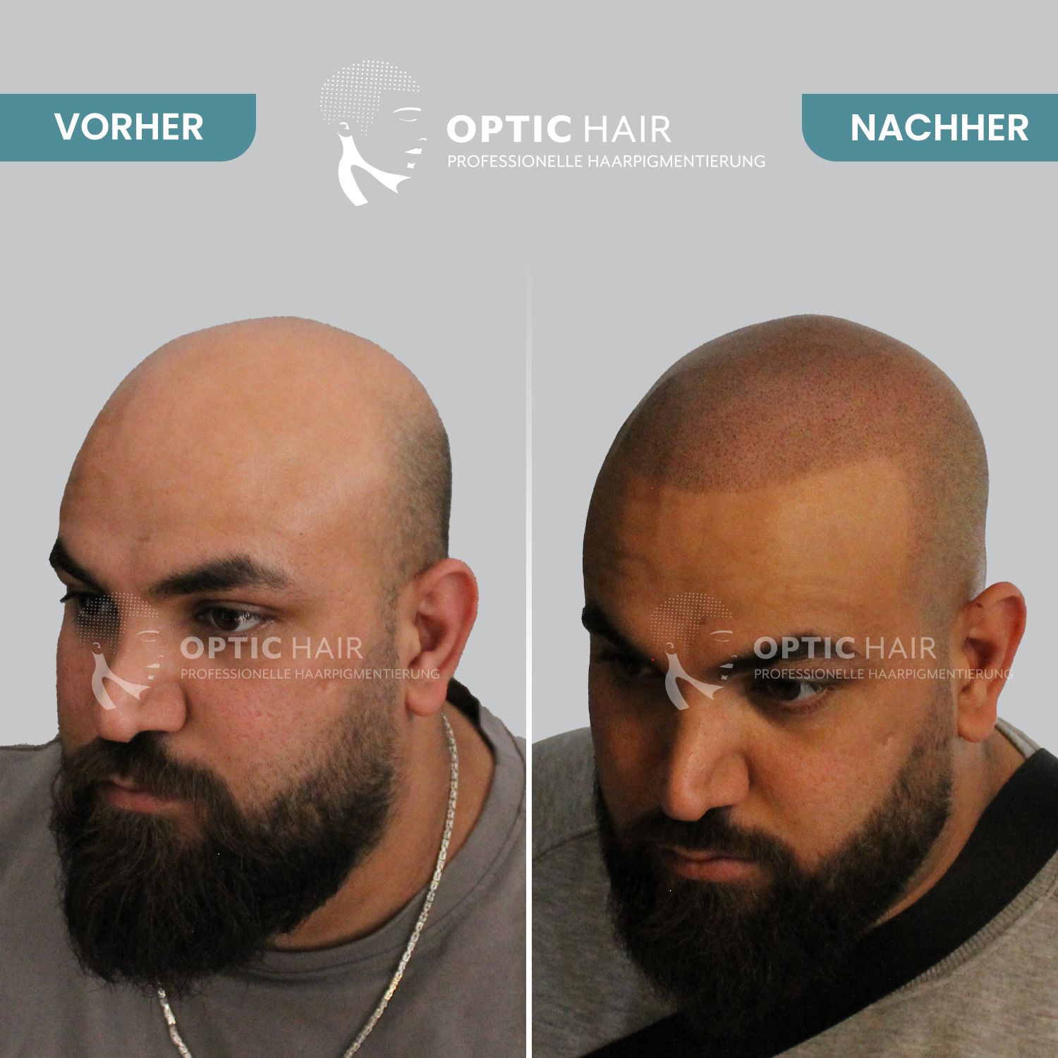Kundenbild groß 24 Haarpigmentierung Köln | OpticHair