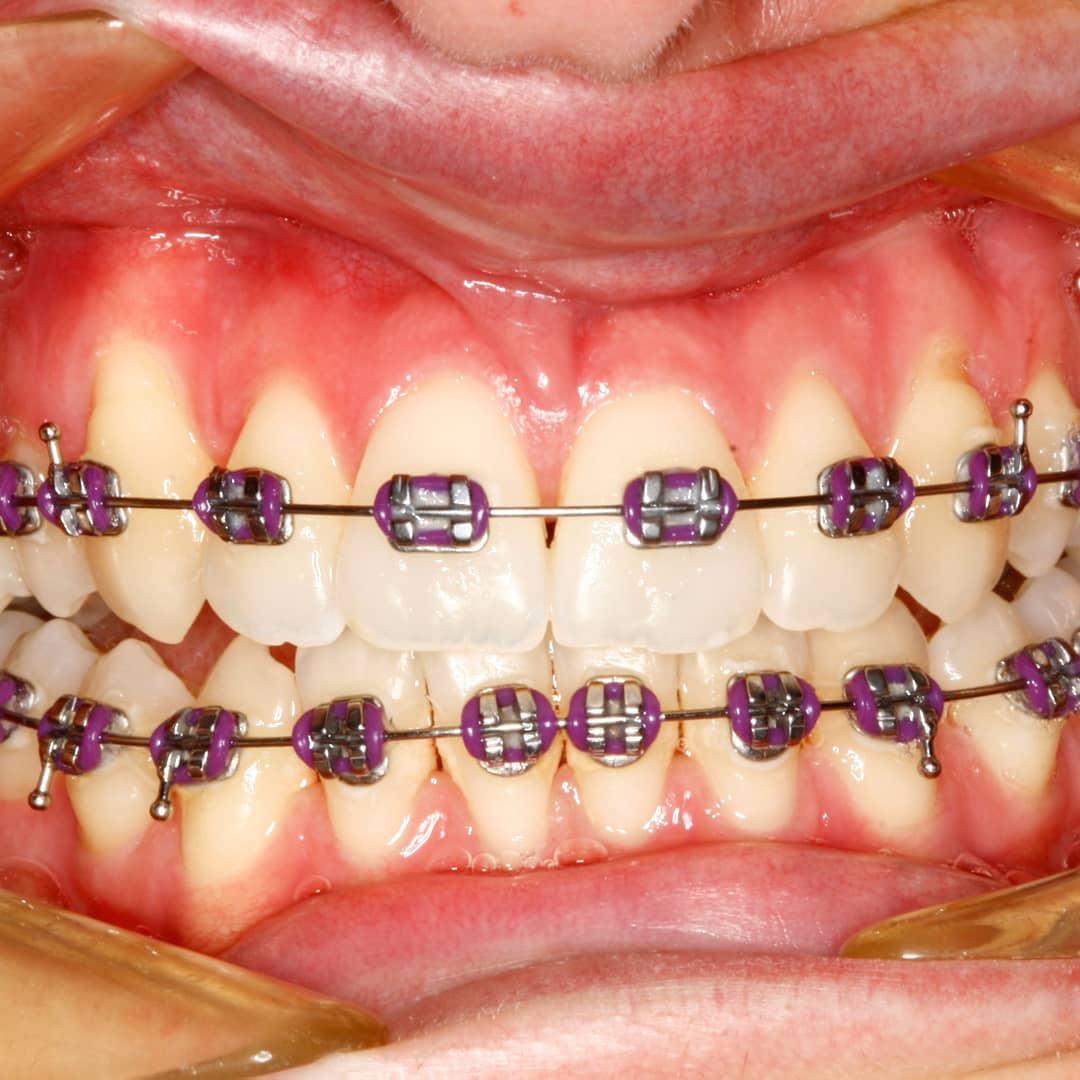Dental Braces in Chicago, IL - InSmyle Dental - Dentist Chicago