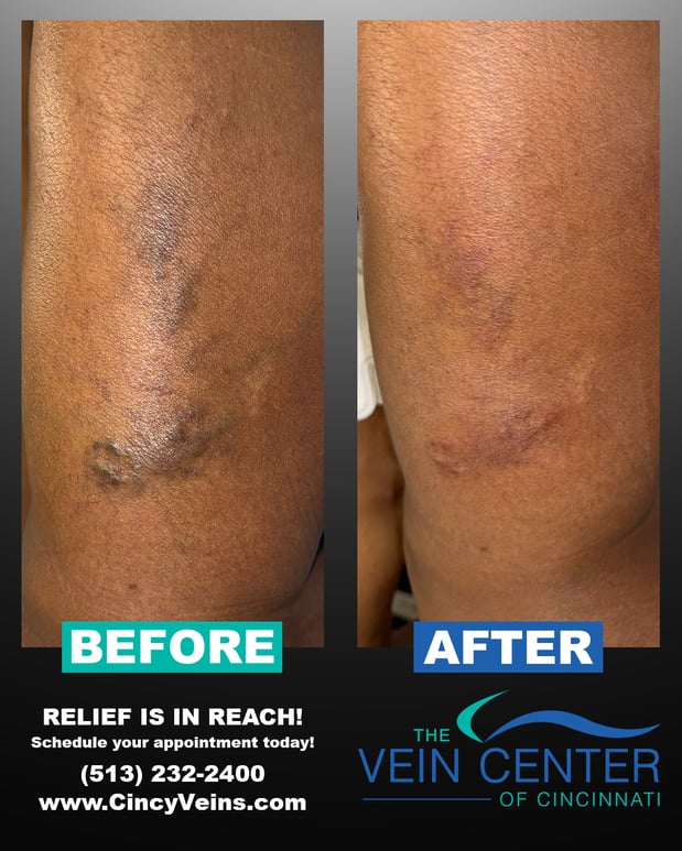 Images The Vein Center of Cincinnati, LLC