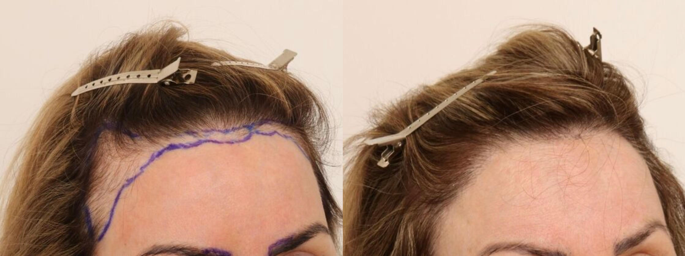 Before and After at The Hair Loss Doctors | New York, NY