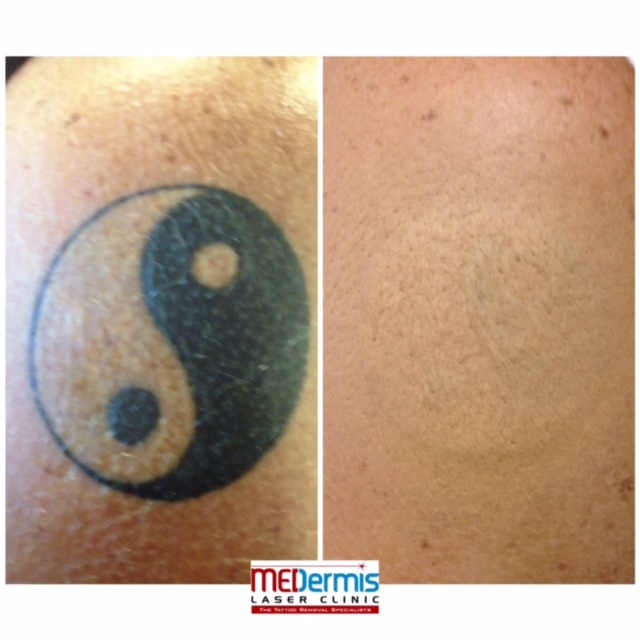 MEDermis Tattoo Removal in San Antonio, TX 78258 ...