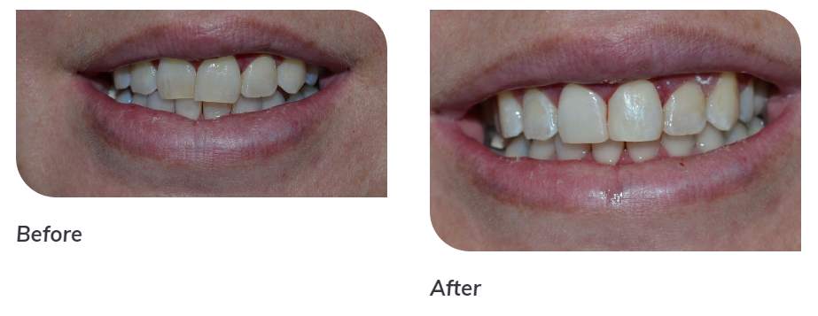 Before & After Results from Peak Family Dentistry | Albuquerque, NM