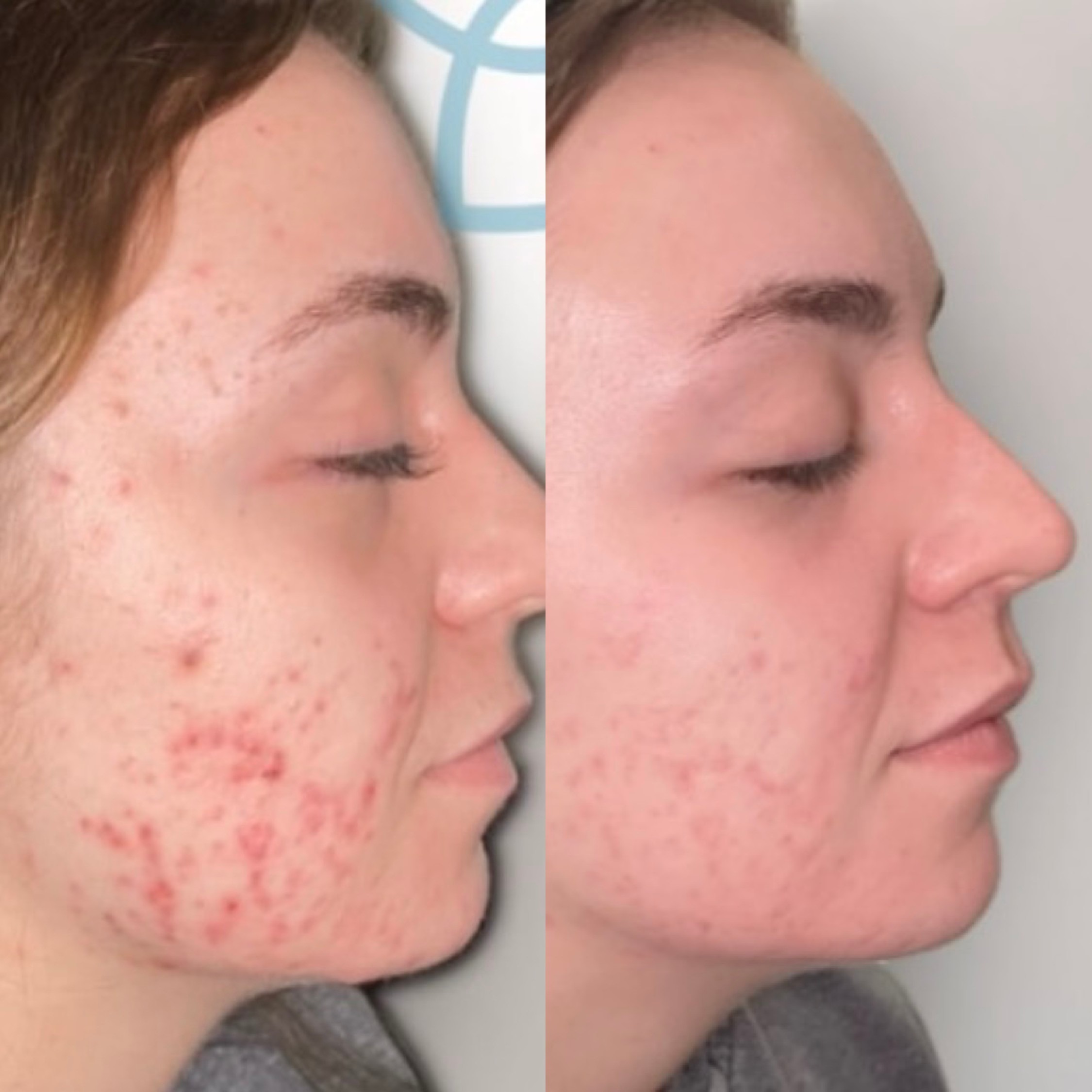 Acne and skin texture treatment before and after, Care Esthetics Delaware