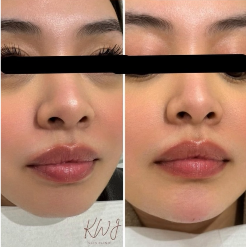 Facial filler before and after image at KWJ Skin Clinic, a trusted aesthetic clinic in Horsham, showing natural-looking dermal filler results, lip filler and facial balancing.