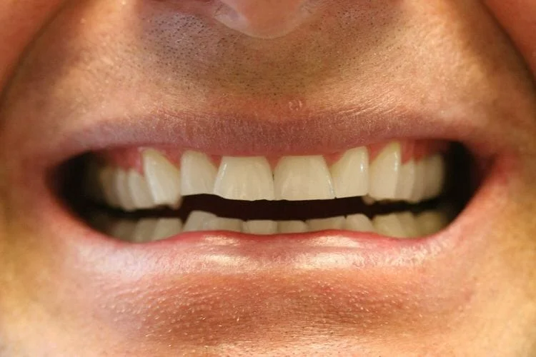 Images Crown Dentistry of the Palm Beaches