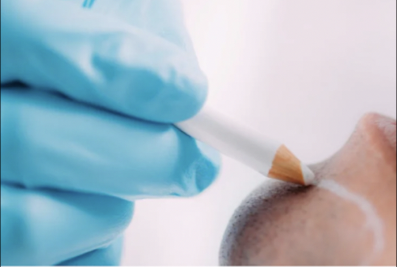 The newest neuromodulator at Modesto Aesthetics and Laser, also known as Daxi, has been proven to have longer lasting results than other neuromodulators such as Botox or Dysport.