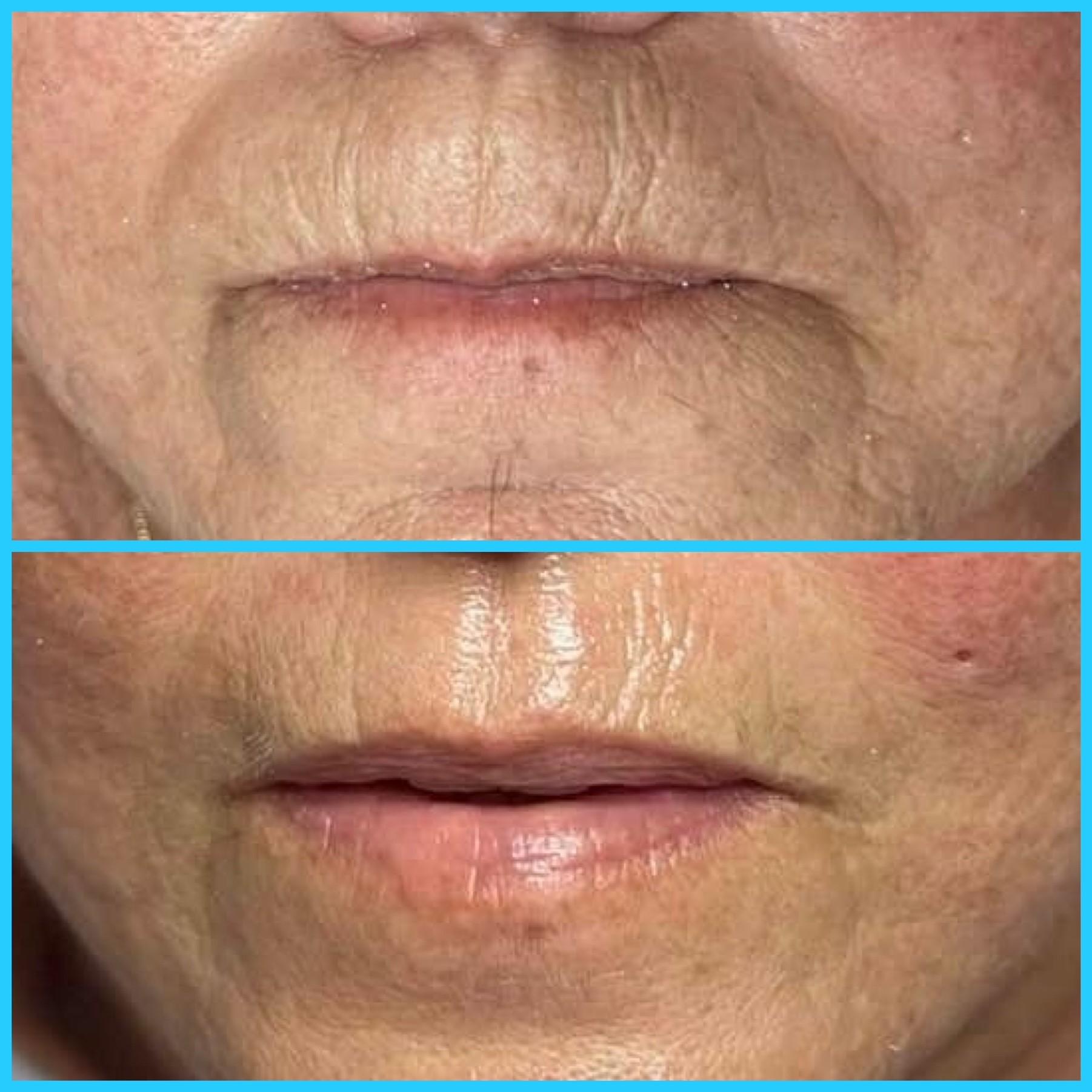 BioRePeel fixes frown and smile lines and wrinkles