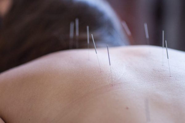 Acupuncture at lotus studios