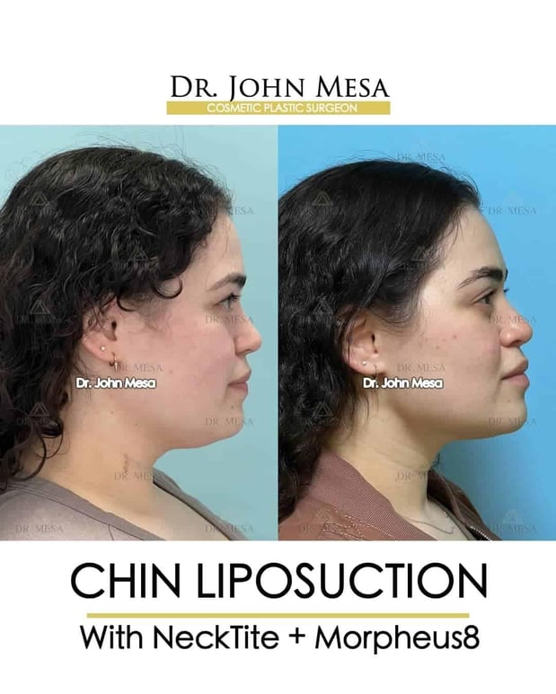Images Dr. John Mesa, MD: Plastic Surgeon NYC, Buccal Fat Removal, Chin Liposuction, Facelift, Facial Masculinization, Chin Implant