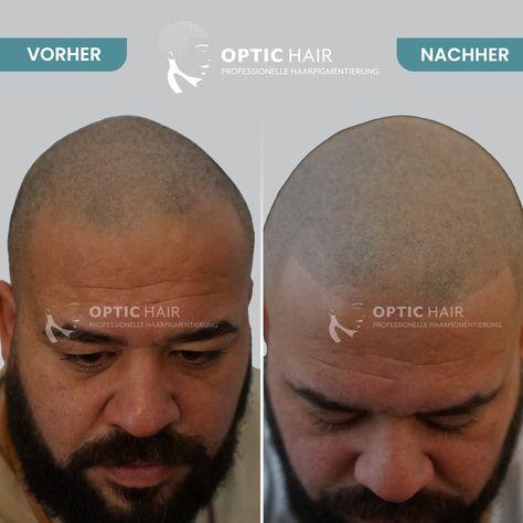 Kundenfoto 38 Haarpigmentierung Köln | OpticHair