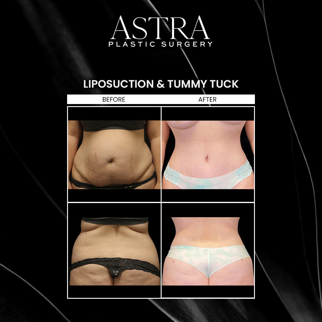 Liposuction can be paired with a tummy tuck to enhance the results of your liposuction surgery. Liposuction and Lipo 360 can remove unwanted fat deposits from specific areas of the body to accentuate your figure and achieve slimmer, more defined contours and curves. A tummy tuck can provide beneficial results by targeting loose skin to tighten and firm the abdominal muscles for an overall flattened midsection and sculpted physique.
