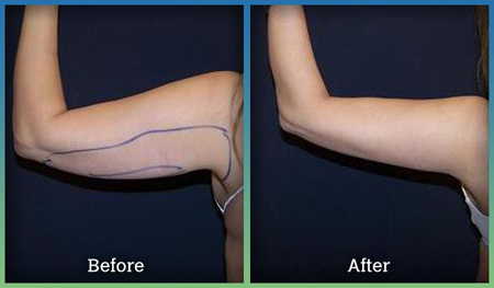 Image 3 | Laser Lipo and Vein Center