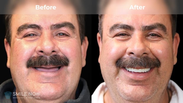 Images Smile Now Milwaukee Dentures and Implants