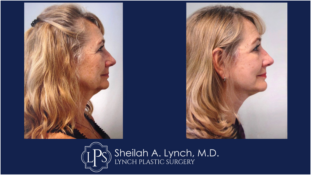 Neck Lift Before & After Patient Chevy Chase Maryland. Plastic Surgeon Near Me Sheilah A. Lynch, MD