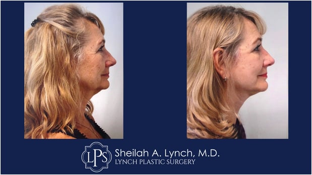 Images Sheilah A. Lynch, MD - Lynch Plastic Surgery