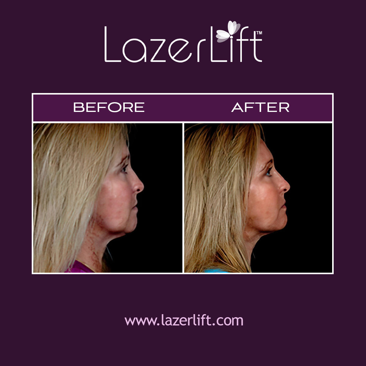 Laser jowl lift in Orlando uses revolutionary LazerLift® technology to improve jawline definition and remove fatty deposits under the chin. LazerLift® provides a gentler approach to diminishing the appearance of jowls when compared to traditional jowl lift surgery. LazerLift® to treat jowls provides a quick, safe, and effective way to improve overall facial appearance.