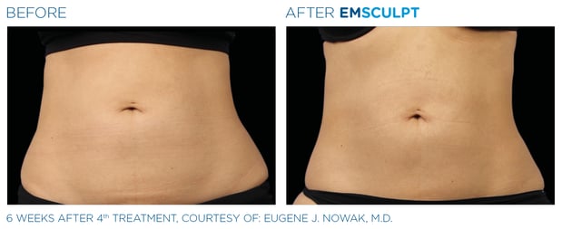 Images Columbus Emsculpt