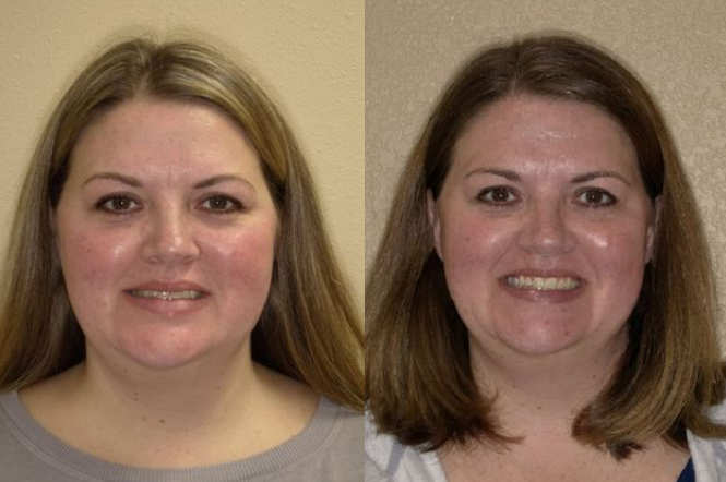Before & After Results at Hulme Orthodontics | San Antonio, TX Hulme Orthodontics San Antonio (210)370-3083
