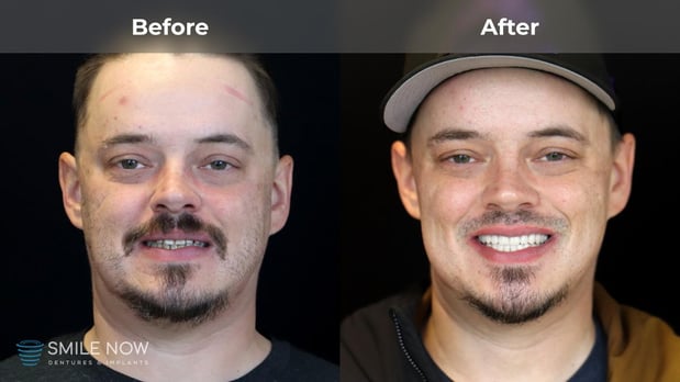 Images Smile Now Milwaukee Dentures and Implants
