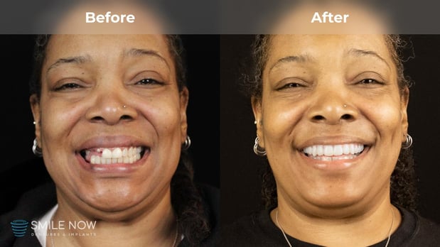 Images Smile Now Milwaukee Dentures and Implants