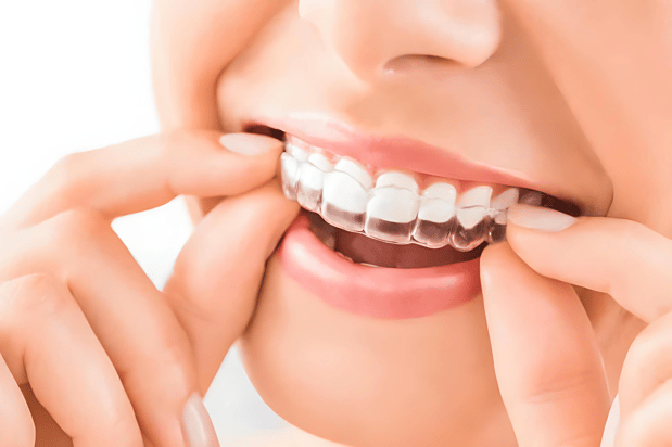 Images Diamond Braces Orthodontist: Braces & Invisalign