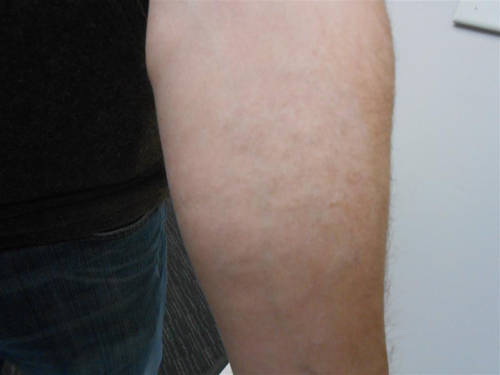 MEDermis Laser Tattoo Removal in San Antonio, TX 78258 