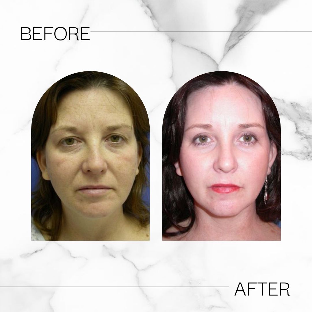 Before & After brow lift results at Devlin Cosmetic Surgery: Michael Devlin, M.D. | Little Rock, AR