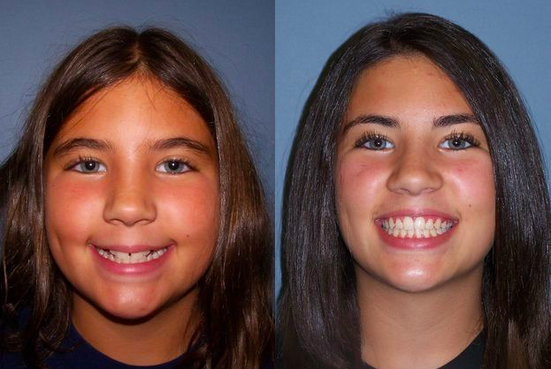 Before & After from Kellyn Hodges Orthodontics | Montgomeryville, PA