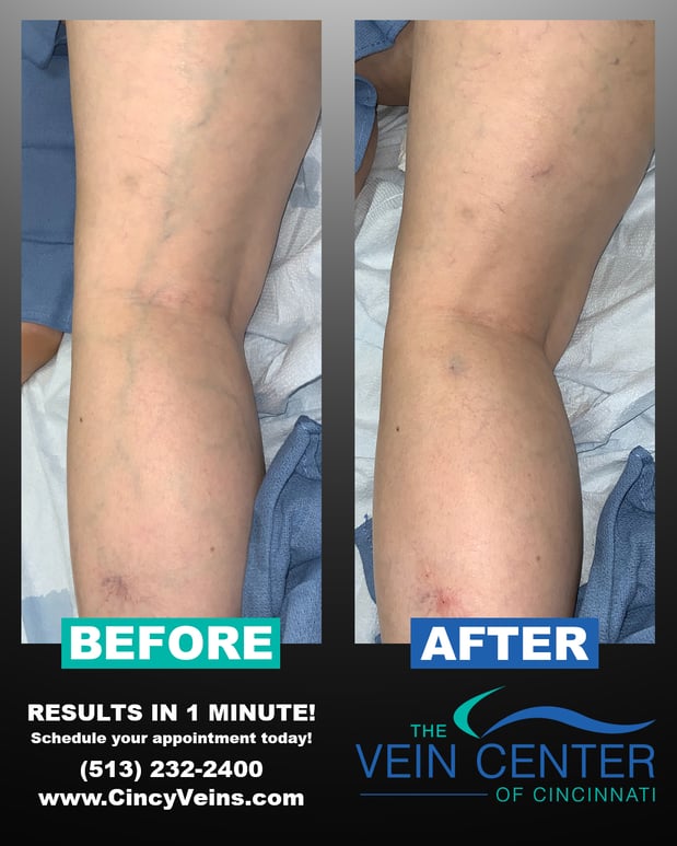 Images The Vein Center of Cincinnati, LLC