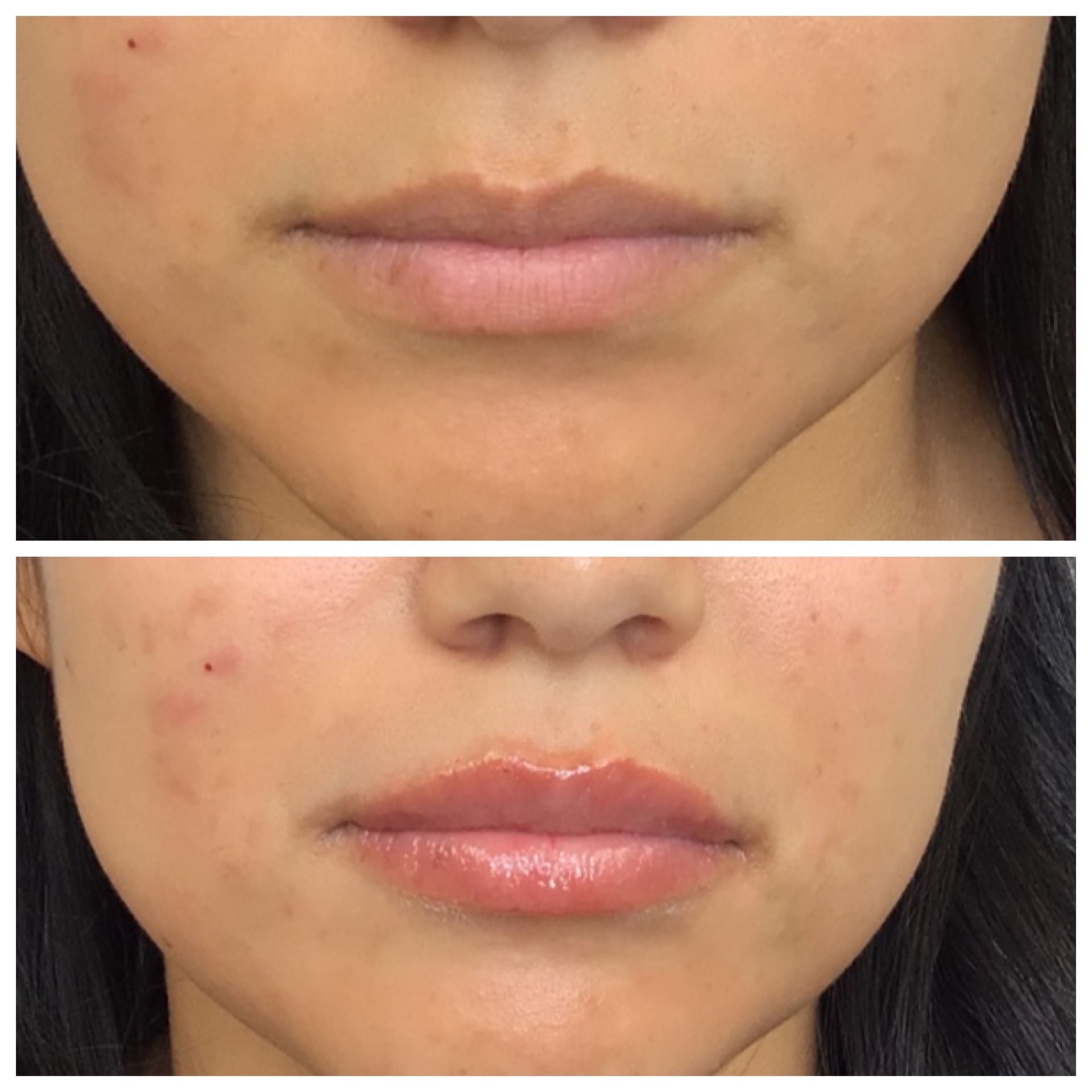 Lip fillers at Magnolia Medical Wellness in Enfield CT