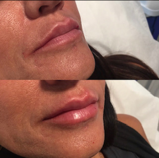 Before and After1 Syringe of Restylane