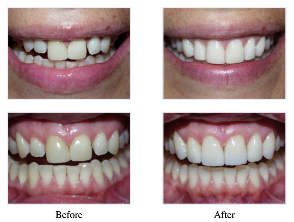 Before & After results at Jean E. Barthman, DDS | Redwood City, CA