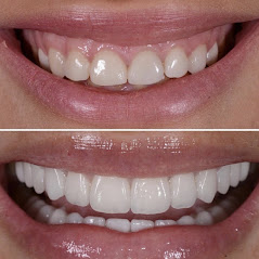 Before and after at NÜVA Smile | West New York, NJ