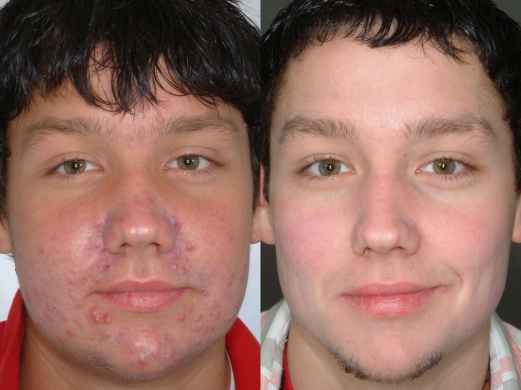 Treatment of Acne with Accutane, Lasers, Light and new Acnion Wash, Pads and Gel invented by Dr. Mark B. Taylor, MD