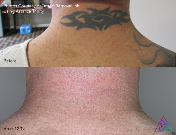 Images Integrity Ink - Laser Tattoo Removal in Crosby, TX
