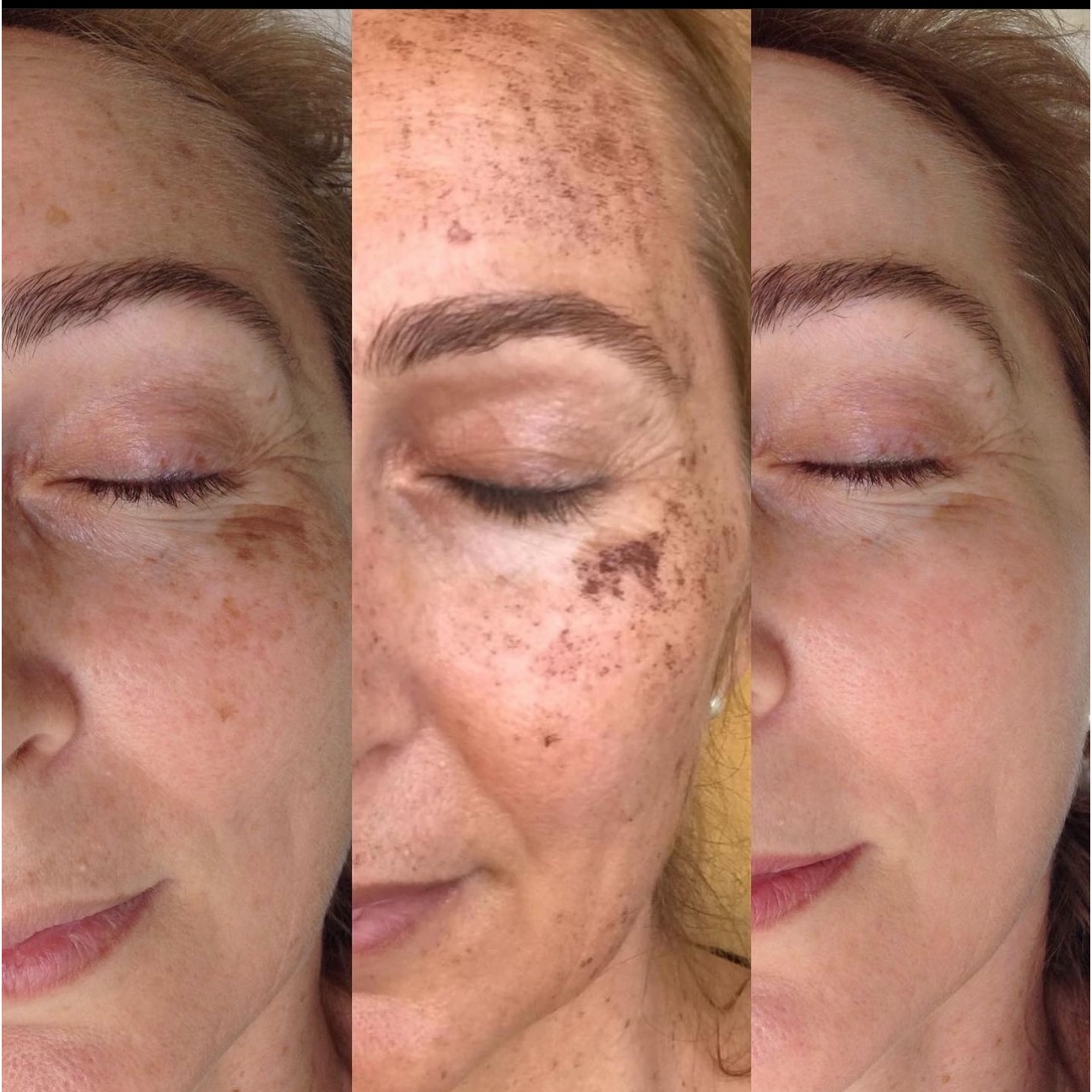 Dark spot and melasma treatment in Colorado Springs by Marysol Gill, designed to visibly improve pigmentation, sun damage, uneven skin tone, and discoloration for a clearer, brighter, more even-looking complexion. A customized skin treatment for clients seeking smoother, healthier-looking skin and visible facial rejuvenation.