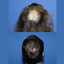 Images BKS Hair Restoration