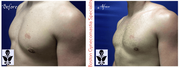 Images Boston Gynecomastia Specialists