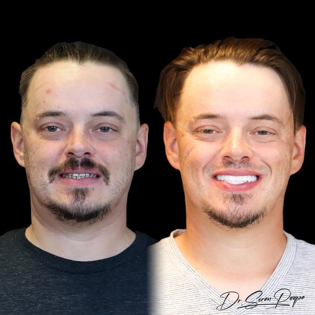 Images Smile Now Denver Dentures and Implants