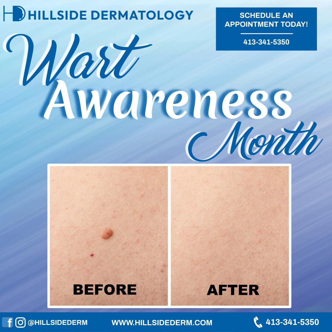 Hillside Dermatology provides the best and most affordable dermatology, acne treatment and atopic dermatitis in Agawam serving Western Massachusetts.