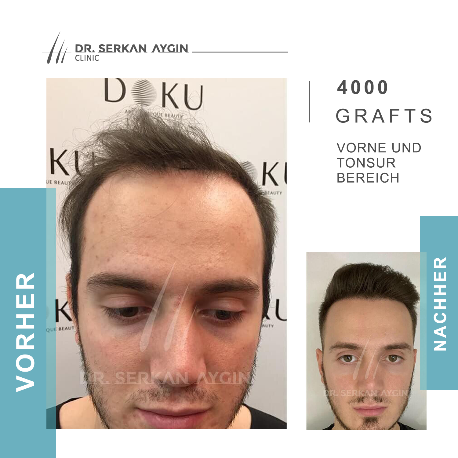 Kundenbild groß 14 Dr Serkan Aygin | Niederlassung Berlin | Haartransplantation Türkei