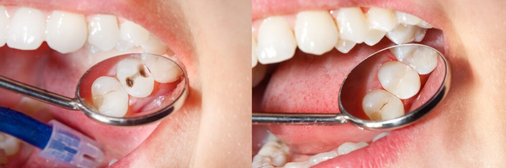 Zahnerhaltung  - Zahnarztpraxis Stefan von Ostranitza |  Zahnarzt Zahnersatz Parodontologie | München